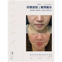 印第安纹剥离