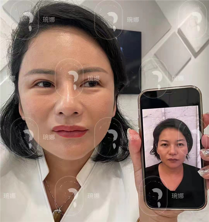 印第安纹剥离
