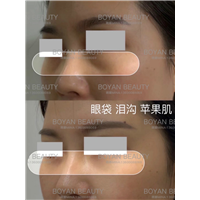 剥离眼袋泪沟