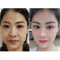 印第安纹剥离