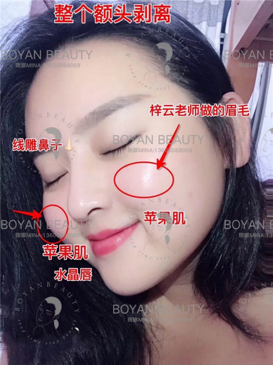 剥离苹果肌