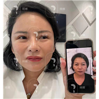 印第安纹剥离