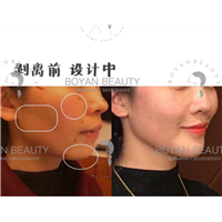 剥离苹果肌