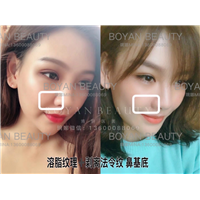 鼻基底剥离好不好
