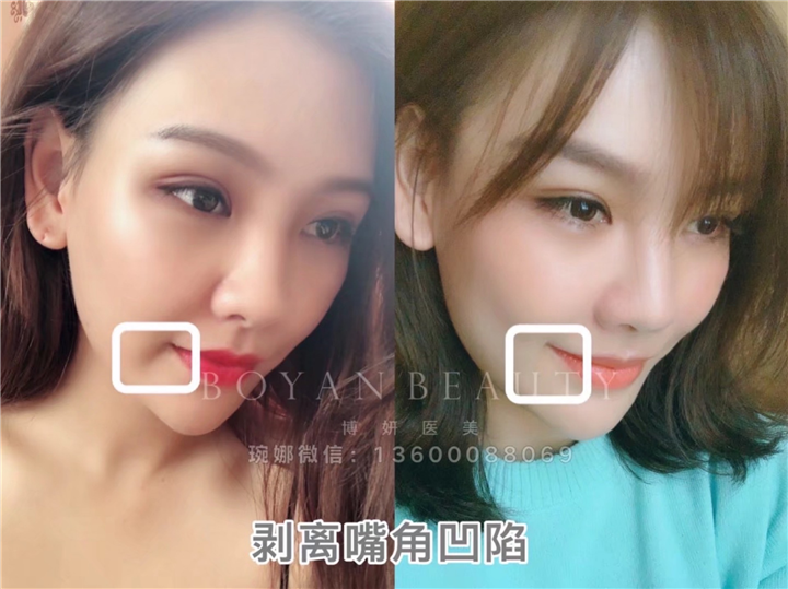 剥离嘴角凹陷