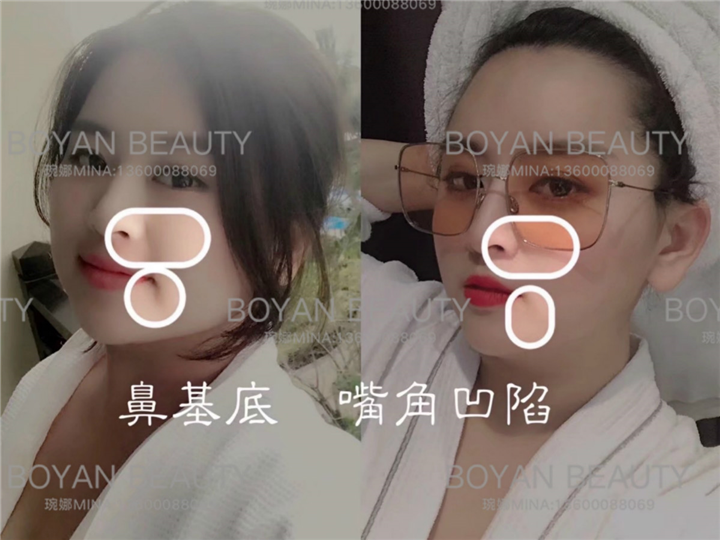 鼻基底凹陷怎么改善