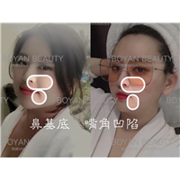 鼻基底凹陷怎么改善