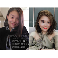 口腔负压