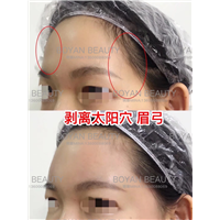 剥离太阳穴