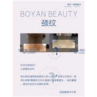 剥离颈纹
