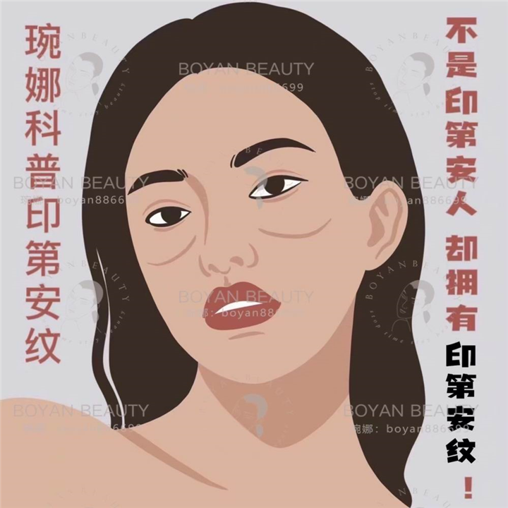 印第安纹剥离