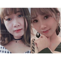 线雕剥离鼻子