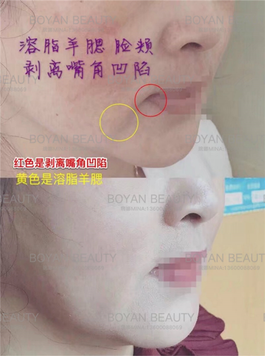 剥离嘴角凹陷