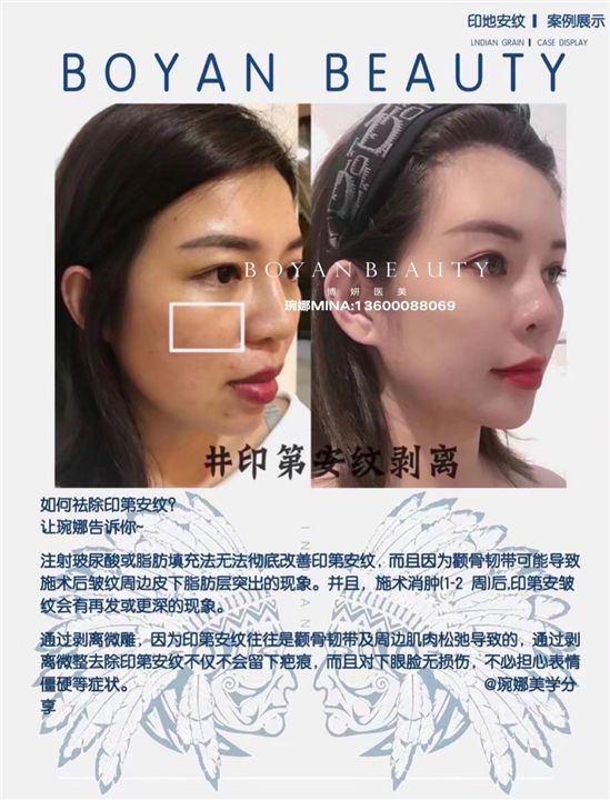 印第安纹剥离