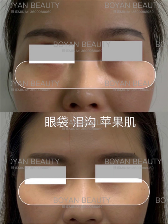 剥离眼袋泪沟