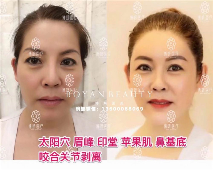 博妍剥离微整