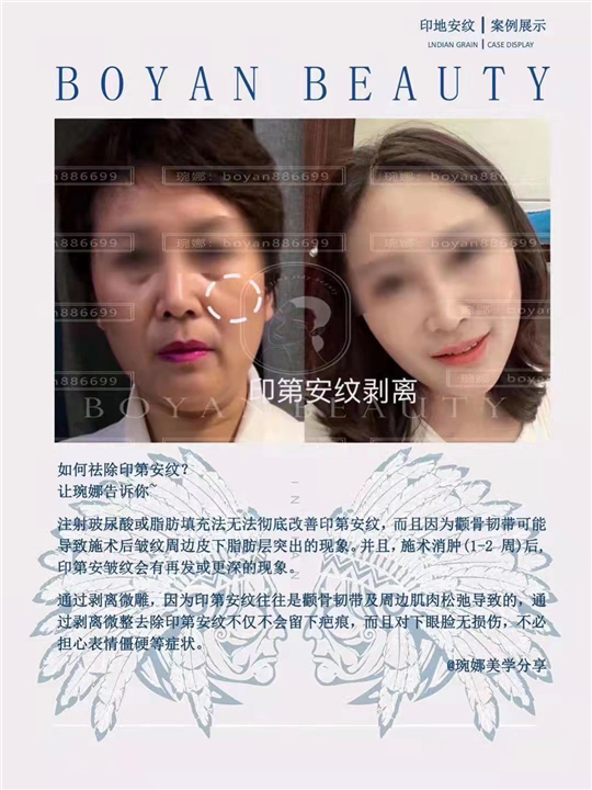 印第安纹如何祛除