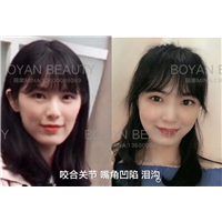 剥离咬合关节