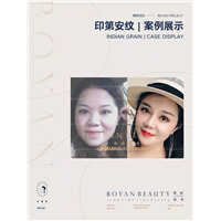 印第安纹剥离