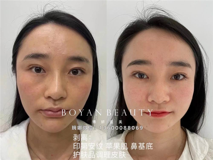 博妍剥离微整