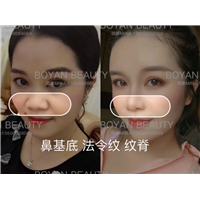 鼻基底剥离是什么