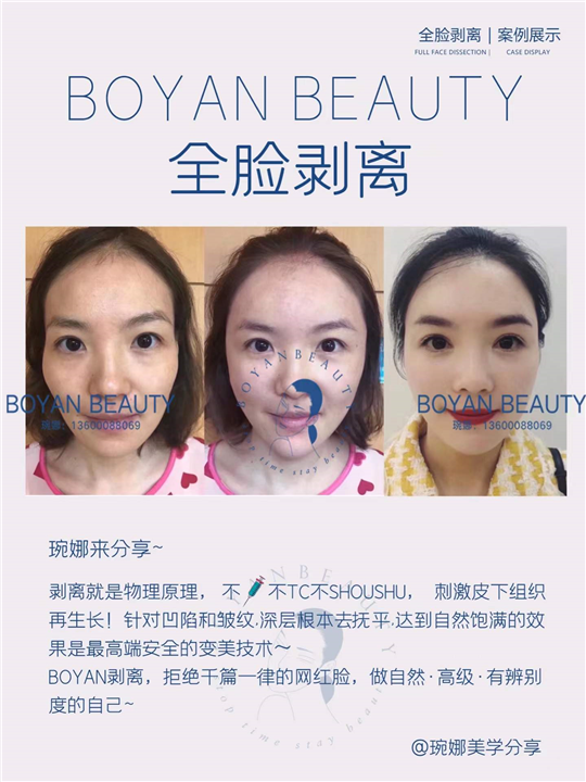 全脸剥离