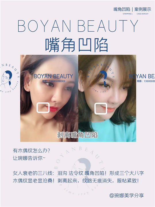 嘴角凹陷