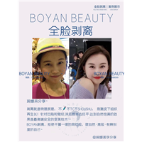 全脸剥离