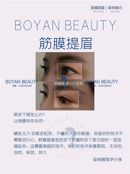 筋膜提眉