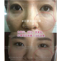 怎么解决印第安纹
