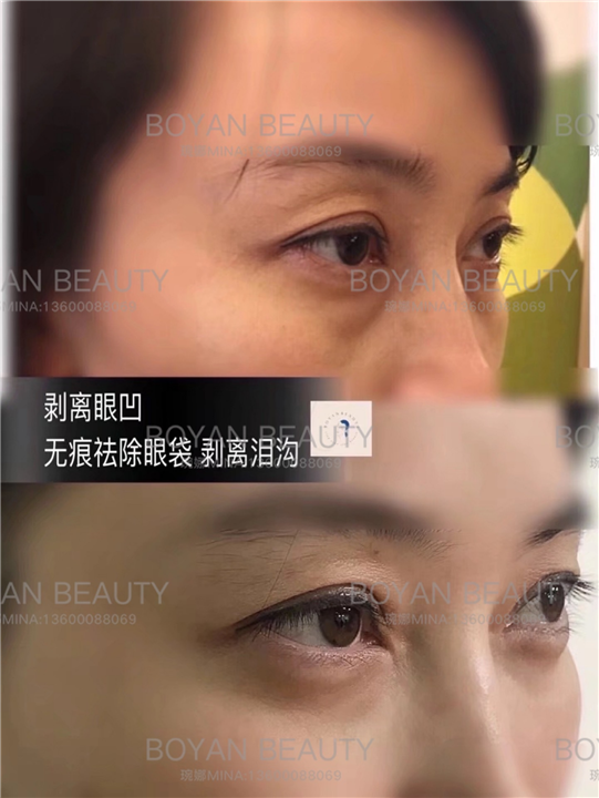 剥离眼凹
