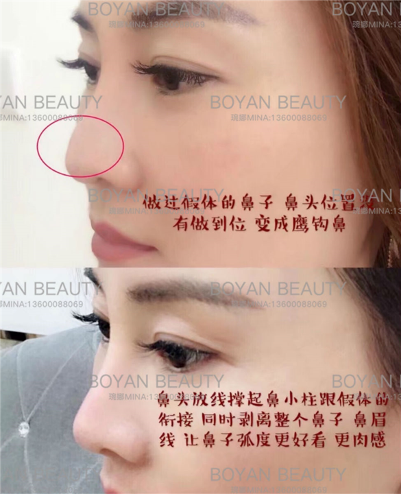 线雕剥离鼻子