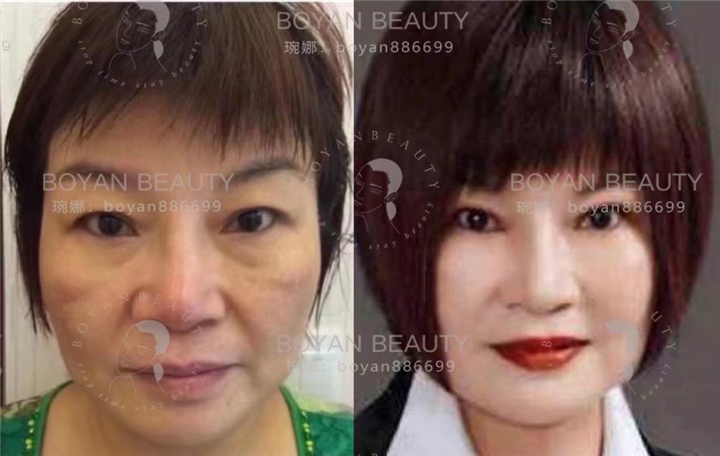 博妍剥离微整