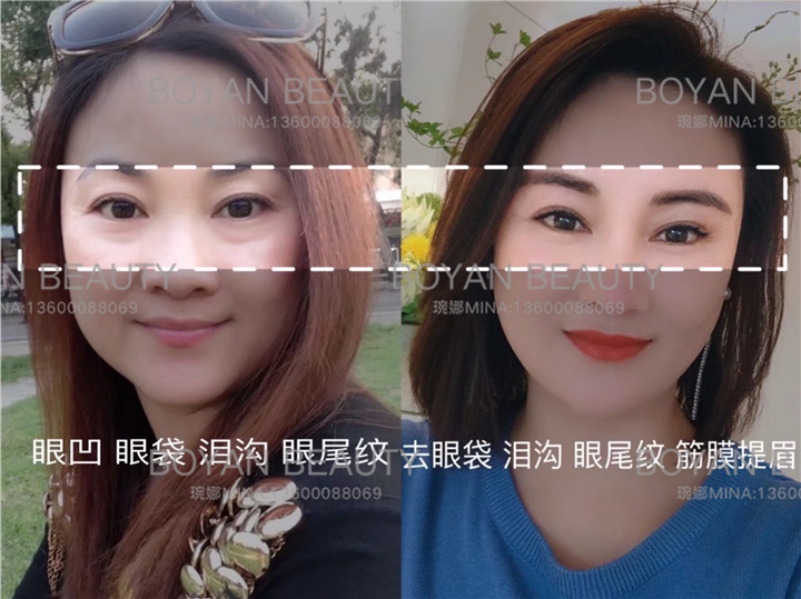 剥离眼袋泪沟