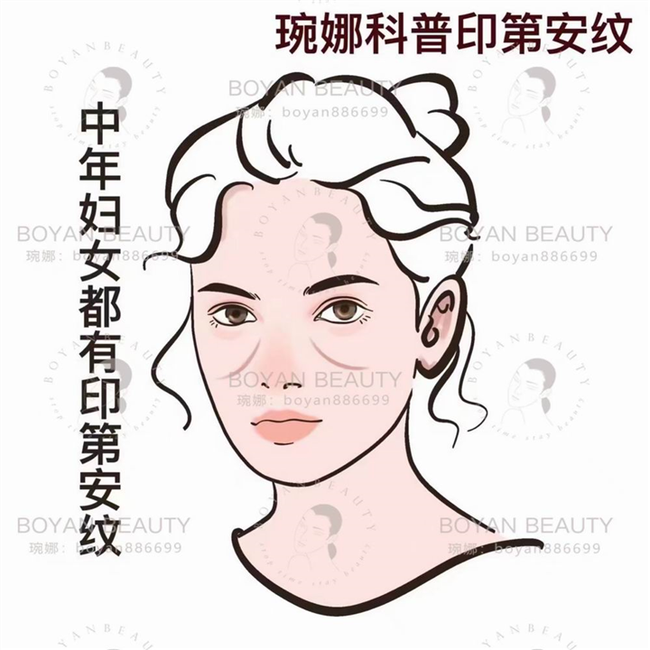印第安纹剥离