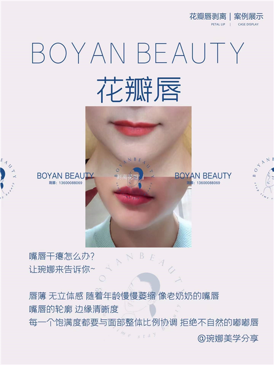 剥离花瓣唇