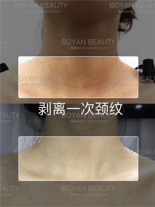 剥离颈纹