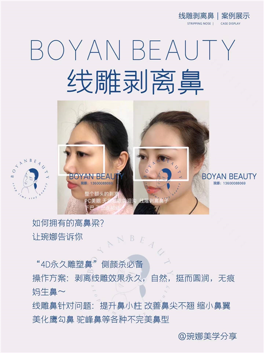 线雕剥离鼻