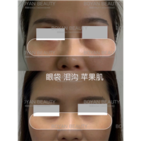 剥离眼袋泪沟