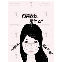 印第安纹剥离