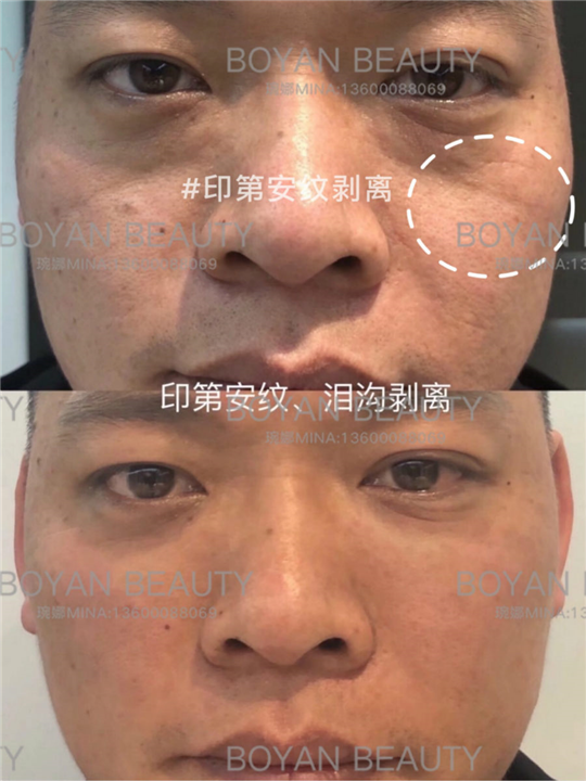 印第安纹剥离微整价格