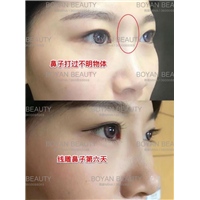 线雕剥离鼻子