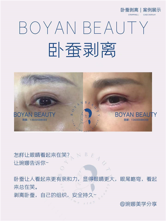 卧蚕剥离
