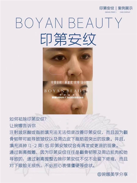 博妍剥离微雕
