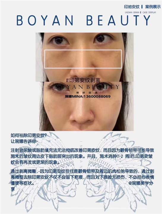 博妍剥离微整