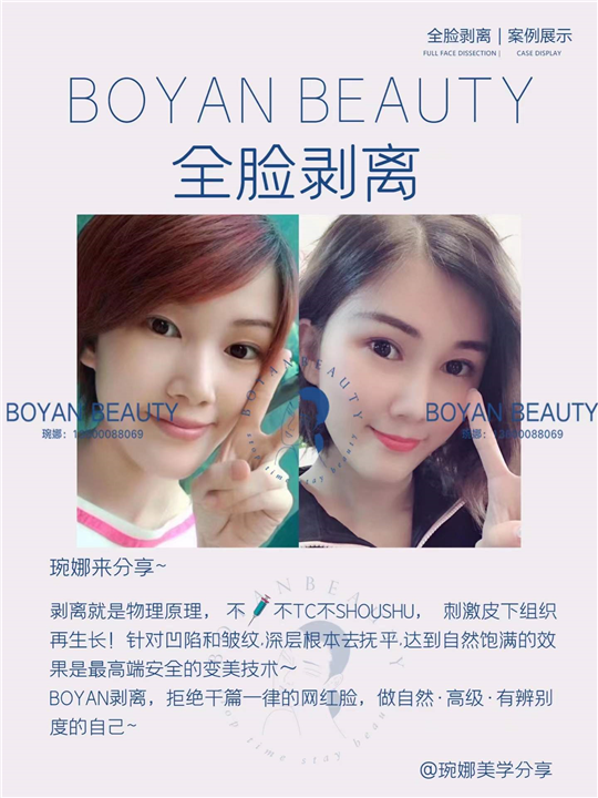 全脸剥离