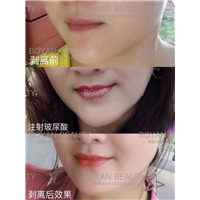 剥离下巴