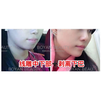剥离下巴