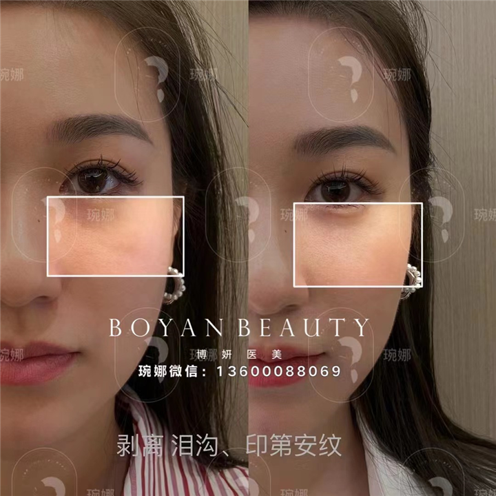 广州印第安纹剥离