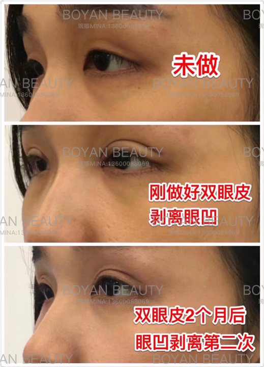 剥离眼凹